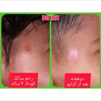 فریز زگیل میخچه/پزشک/بهارستان/خالبرداری|خدمات آرایشگری و زیبایی|اصفهان, بهارستان|دیوار