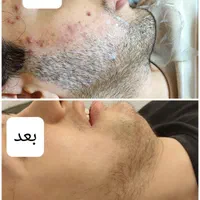 الکترولیز موهای سفیدمشکی خانم وآقا(متفاوت با لیزر)|خدمات آرایشگری و زیبایی|بندر ماهشهر, |دیوار