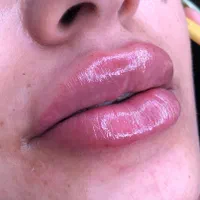 تزریق ژل لب،تزریق ژل گونه ،تزریق ژل چانه، بوتاکس|خدمات آرایشگری و زیبایی|ساری, |دیوار
