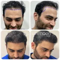 کاشت مو و ابرو تیم شیرازی در قزوین ، جشنواره اقساط