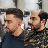 پروتز مو|خدمات آرایشگری و زیبایی|تهران, شهرک ولیعصر جنوبی|دیوار