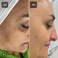 جشنواره خدمات تخصصی لیزر و فیشیال،برداشتن خال و لک