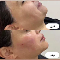 تزریق ژل بوتاکس لیفت نخ هایفو بلفاروپلاستی لیزر|خدمات آرایشگری و زیبایی|مشهد, کوه سنگی|دیوار
