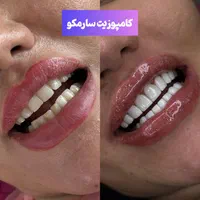 کامپوزیت،لمینیت،روکش،بلیچینگ در دندانپزشکی کیانمهر|خدمات آرایشگری و زیبایی|کرج, کیانمهر|دیوار