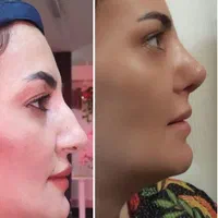 تخفیف۵۰درصدی عمل بینی ب مناسبت مبعث رسول|خدمات آرایشگری و زیبایی|تهران, شهرک غرب|دیوار