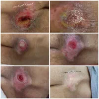 تزریقات درمنزل سرم کارشناس زخم.اصفهان و اطراف|خدمات آرایشگری و زیبایی|اصفهان, پارک مشتاق|دیوار