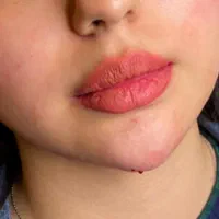 جشنواره تزریق ژل و بوتاکس مزوتراپی مزوژل|خدمات آرایشگری و زیبایی|شیراز, تحویلی|دیوار