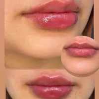 ژل لب گونه،بوتاکس،فیلر بادی صرفا توسط پزشک|خدمات آرایشگری و زیبایی|اهواز, کیانپارس |دیوار