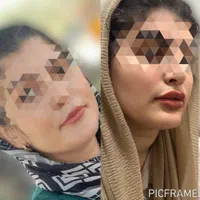 بوتاکس ، فیلر کل صورت ، مزو تراپی ، خال برداری