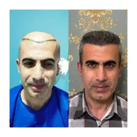 کاشت مو  ابرو  ریش به روش شیرازی|خدمات آرایشگری و زیبایی|سنندج, |دیوار
