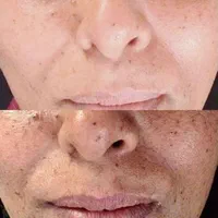 آموزش تخصصی کرم پودرفشیال مزونیدل اسکالپ سر وخدمات|خدمات آرایشگری و زیبایی|مشهد, جانباز|دیوار
