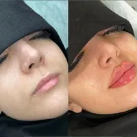 تخفیف بوتاکس، فیلر، بلفاروپلاستی، لاغری و فیشال|خدمات آرایشگری و زیبایی|تهران, ظفر|دیوار