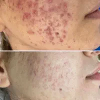 کلینیک پوست/درمان لک/جوش جای جوش/مزونیدلینگ/فشیال|خدمات آرایشگری و زیبایی|مشهد, فرهنگ|دیوار
