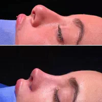 عمل جراحی زیبایی بینی،گوش،لیفت صورت