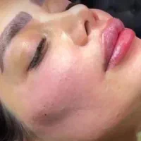 ژل بوتاکس فیلر بلفارو توسط پزشک