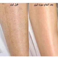 لیزر موهای زائدتضمینی 2025 بی درد ریموتتو هایفو|خدمات آرایشگری و زیبایی|تهران, صادقیه|دیوار