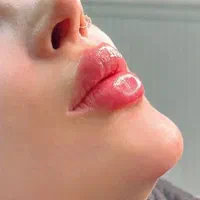 جشنواره تزریق ژل و بوتاکس مزوتراپی مزوژل|خدمات آرایشگری و زیبایی|شیراز, تحویلی|دیوار