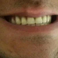 دندان مصنوعی متحرک (تحویل ۳ روزه)