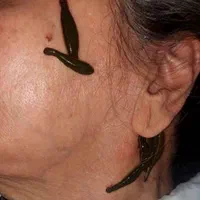 زگیل تناسلی حجامت بادکش فصدخون زالو درمانی طب سوزن|خدمات آرایشگری و زیبایی|اصفهان, خانه اصفهان|دیوار