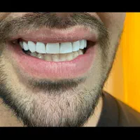 کامپوزیت دندان|خدمات آرایشگری و زیبایی|اسلام‌شهر, شهرک مهدیه|دیوار