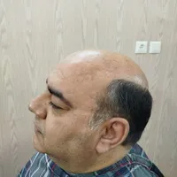 پروتز و ترمیم موی افشان