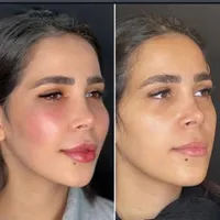 تخفیف بوتاکس، فیلر، بلفاروپلاستی، لاغری و فیشال|خدمات آرایشگری و زیبایی|تهران, ظفر|دیوار