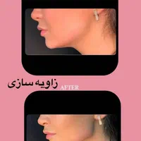 تزریق ژل لب بوتاکس هایفولیزرفیلرلیفت صورت سفیدسازی|خدمات آرایشگری و زیبایی|تهران, صادقیه|دیوار