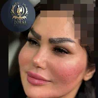 تزریق ژل و بوتاکس و مادلینگ خلیجی و هایفو درکلینیک|خدمات آرایشگری و زیبایی|کرمانشاه, |دیوار