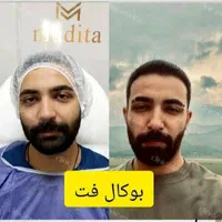بوکالفت/ساکشن غبغب/ساکشن شکم/تزریق چربی باسن/فیلر|خدمات آرایشگری و زیبایی|تهران, صادقیه|دیوار