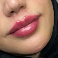 مطب تخفیف ژل و فیلر لب و صورت و بوتاکس|خدمات آرایشگری و زیبایی|قم, صفائیه|دیوار