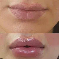 لیزر موی زاید بوتاکس هایفو ژل پی ارپی فشیال|خدمات آرایشگری و زیبایی|تهران, هاشمی|دیوار