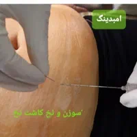 امبدینگ موکساتراپی حجامت طب سوزنی بادکش فصد زگیل|خدمات آرایشگری و زیبایی|اصفهان, مسجد مصلی|دیوار