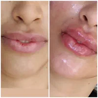 خدمات ژل وبوتاکس. تتو وانزیم وپرسینگ|خدمات آرایشگری و زیبایی|مشهد, شهرک شهید باهنر|دیوار