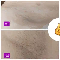 جشنواره بهاری لیزر موی زائد فول ۴۲۰ به مدت محدود|خدمات آرایشگری و زیبایی|ارومیه, |دیوار