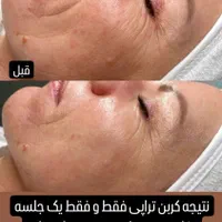 کربن هالیوودی و ریمو تتومشکی و رنگی|خدمات آرایشگری و زیبایی|ارومیه, |دیوار