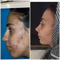 تخفیف۵۰درصدی عمل بینی ب مناسبت مبعث رسول|خدمات آرایشگری و زیبایی|تهران, شهرک غرب|دیوار