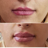بوتاکس ژل فیلر مزوتراپی لیزر هایفو لیفت نخ در مطب|خدمات آرایشگری و زیبایی|اصفهان, مسجد مصلی|دیوار