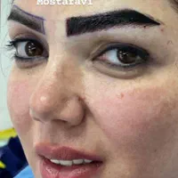 کاشت مو و ابرو با بروز ترین متد کاشت (تبریز)|خدمات آرایشگری و زیبایی|زنجان, |دیوار