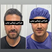 جراحی زیبایی بینی فقط با 22 میلیون|خدمات آرایشگری و زیبایی|قائم‌شهر, |دیوار