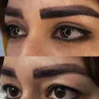 بلفاروپلاستی پلک توسط پزشک جراح