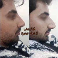 تزریق آنزیم بینی/فیلر بینی/شقیقه/ژل/درکلینیک پزشکی|خدمات آرایشگری و زیبایی|شیراز, زرهی|دیوار