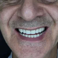 دندان مصنوعی باجدیدترین متد جهانی بدونه لقی