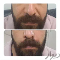 تزریق، فیلر ، بوتاکس، ژل ، آنزیم|خدمات آرایشگری و زیبایی|شیراز, سینما سعدی|دیوار