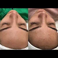 پاکسازی پوست فشیال لیزر پوست فیشیال|خدمات آرایشگری و زیبایی|شیراز, درکی|دیوار