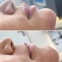 ژل /بوتاکس فیلر لب روسی اموزش بوتاکس آنزیم چربی|خدمات آموزشی|خرم‌آباد, |دیوار