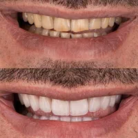 دندانپزشکی زیبایی لمینت کامپوزیت روکش بلیچینگ