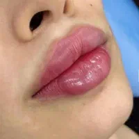 ژل لب/گونه/بوتاکس/فیلربینی/مزوپی ار پی|خدمات آرایشگری و زیبایی|مشهد, سجاد شهر|دیوار