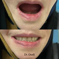 ساخت دست دندان مصنوعی طرح لمینیت و لبخند باضمانت|خدمات آرایشگری و زیبایی|تهران, طیب|دیوار