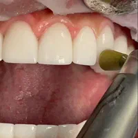 آموزش کامپوزیت دندان و دندانسازی