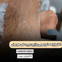 الکترولیز.پیرسینگ.پلاسما.خالبرداری|خدمات آرایشگری و زیبایی|سنندج, |دیوار